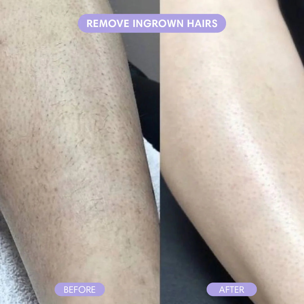 a close up of a person's legs with text: 'REMOVE INGROWN HAIRS BEFORE AFTER'